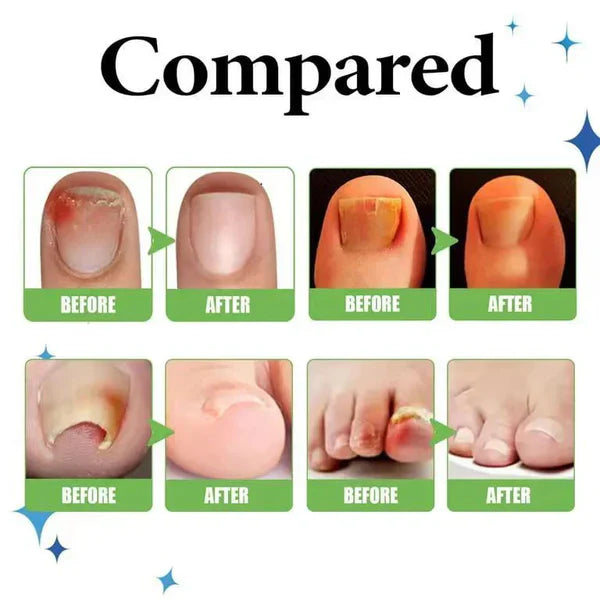 Anti Paronychia Relief Oil for Nail Infection & Ingrown Nails | Buy 1 Get 1 FREE