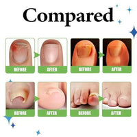 Before and after comparison of nail conditions after using Dr. Orthonex nail oil